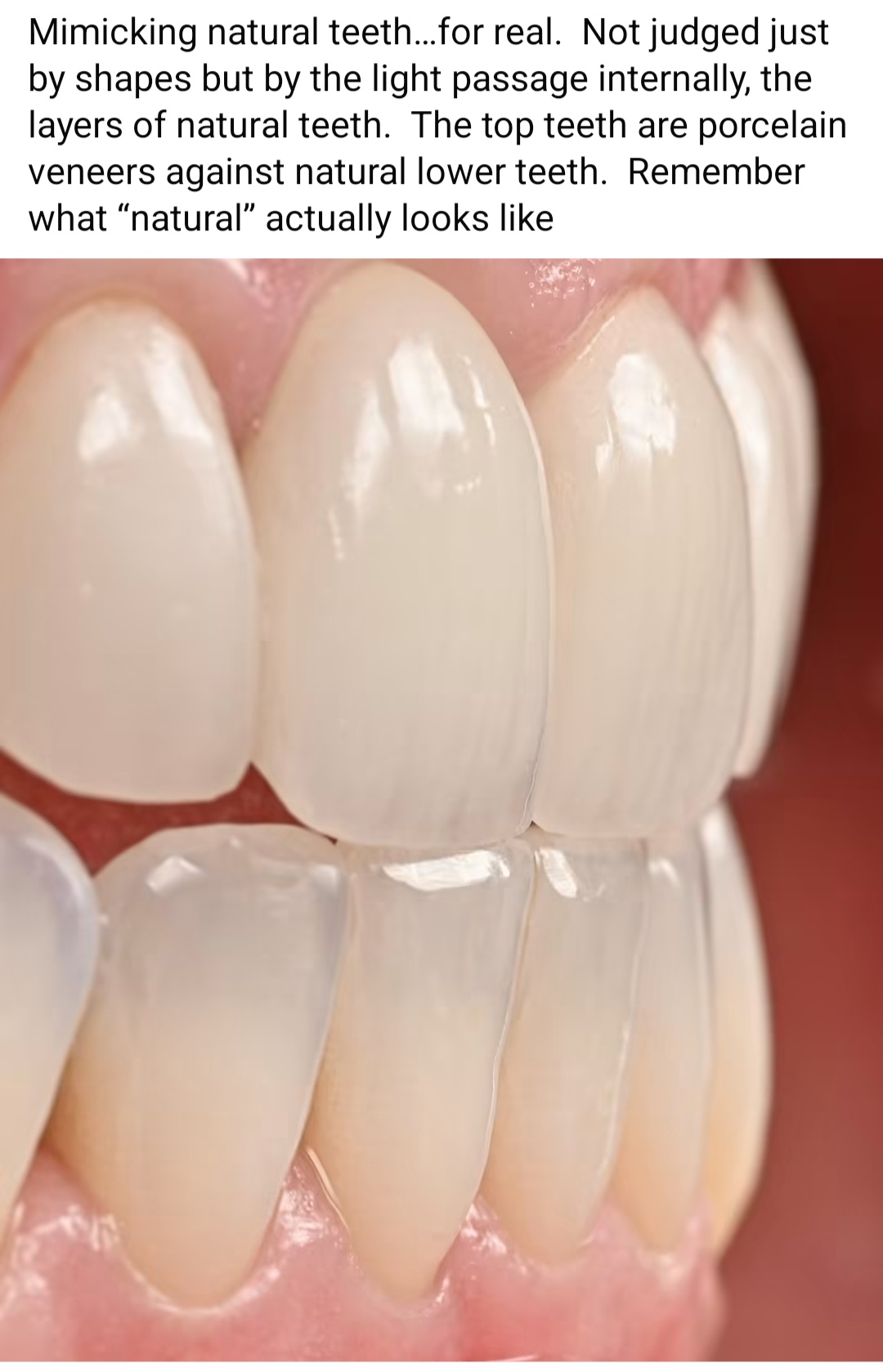 Porcelain veneers on the upper teeth, designed to mimic the natural light and layers of real teeth.