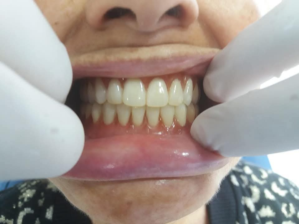 Aesthetic restoration with ceramic crowns for a harmonious, natural result.