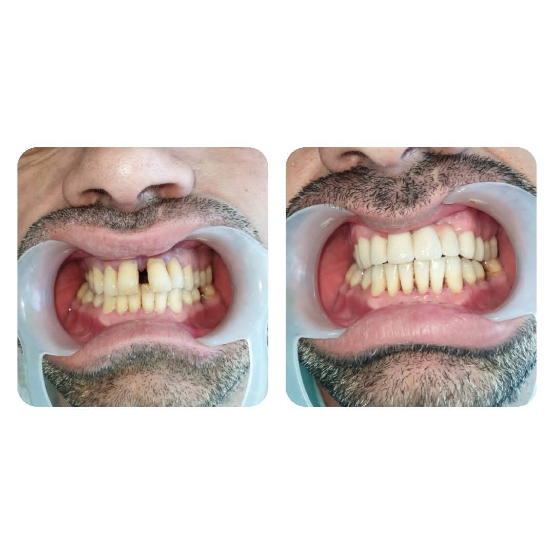 Before and after: full smile rehabilitation with crowns and gum treatment.