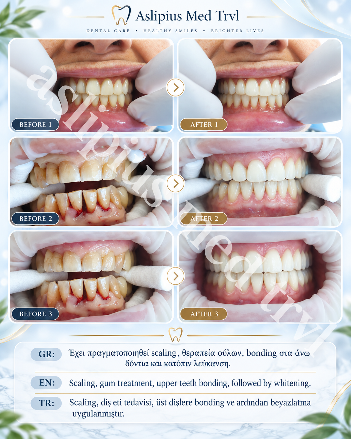 Scaling, gum treatment, upper teeth bonding, followed by whitening.