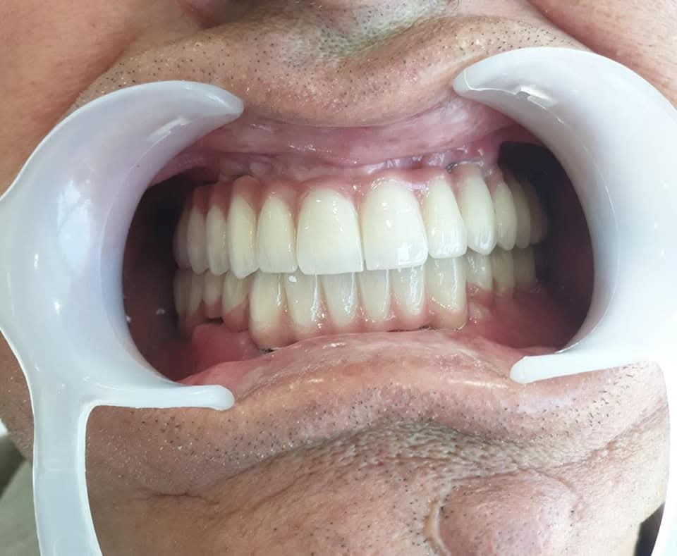 Full-mouth implant restoration — a complete, natural-looking new smile.